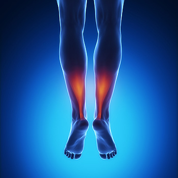 The Treatment of Achilles Tendonitis Using Therapeutic Laser