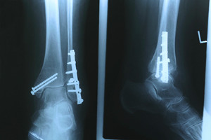 Understanding the Basics of Stress Fractures