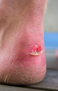 skin blisters causes