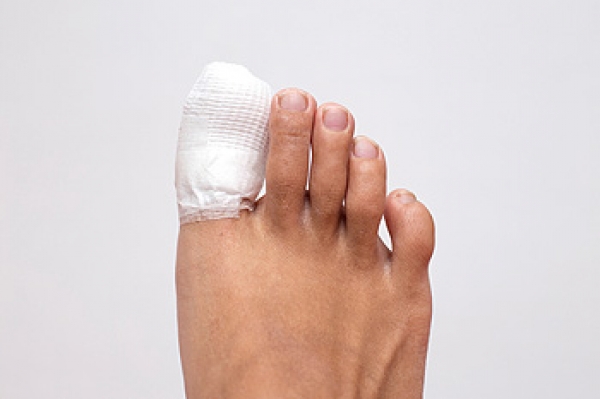 What to Know About Broken Toes 