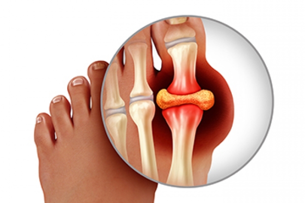 What Are the Risk Factors for Developing Gout