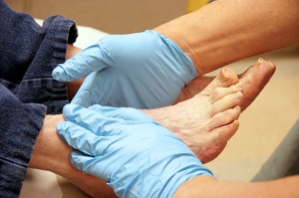 Diabetic Patients and the Inability to Feel Cuts on Their Feet