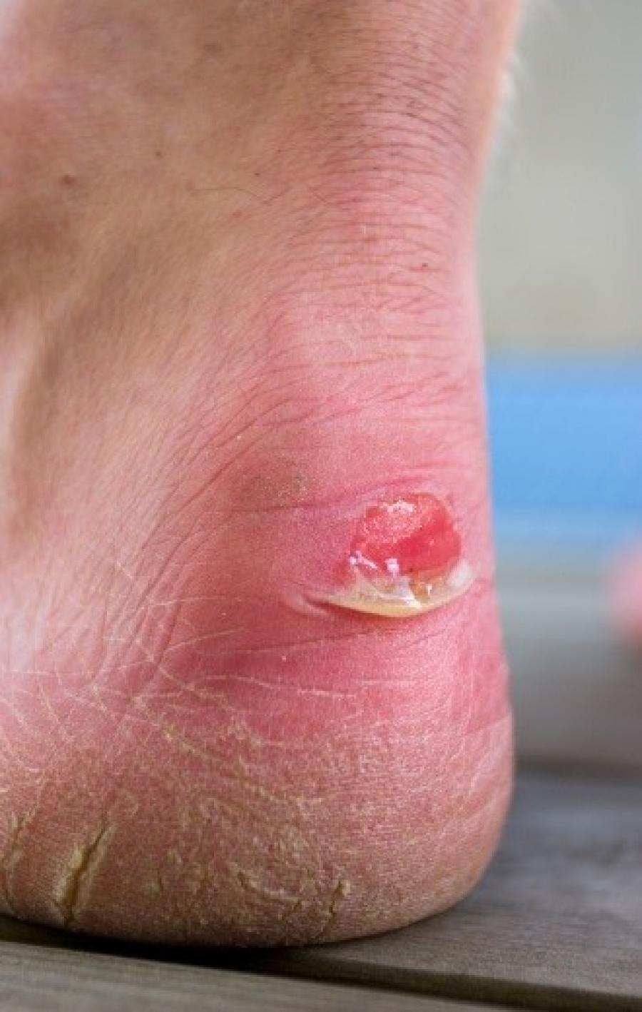 Prevent Blisters