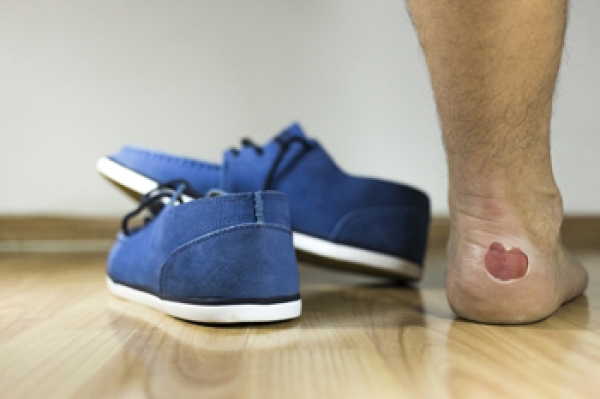 Why Do Blisters Develop on the Feet?