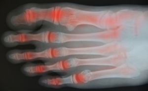 What is Joint Replacement Surgery?